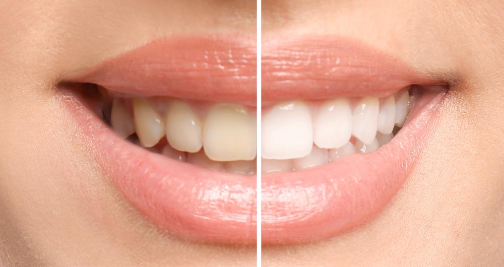 teeth whitening example | Narre Warren Dentist