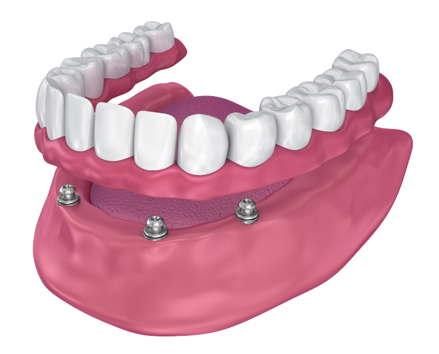 all-on-x implants in narre warren