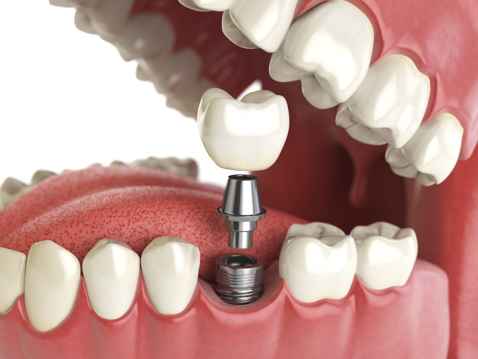 dental implant diagram | Narre Warren Dentist