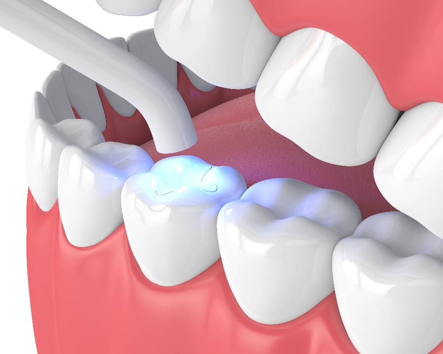 Tooth-colored fillings diagram | Narre warren
