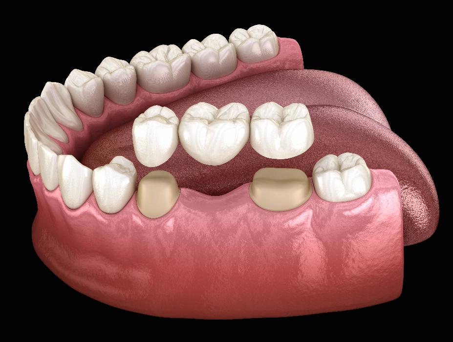 dental bridge diagram | narre warren south dentist