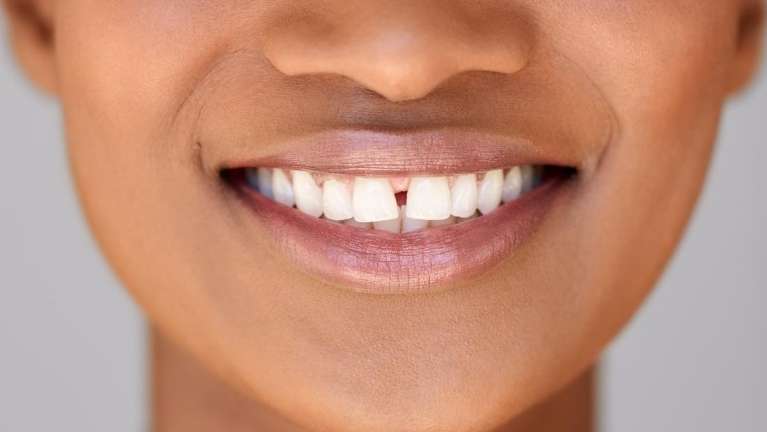 cosmetic dentist narre warren | person with a fap in their front teeth