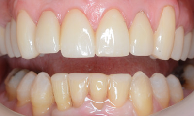 After treatment - Clear Aligners and Crowns/Veneers 