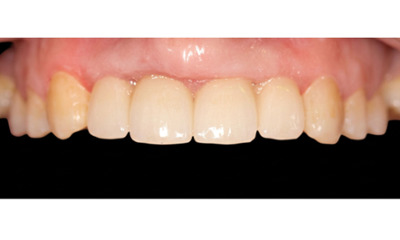 After treatment - Dental Implant and Bridge Treatment
