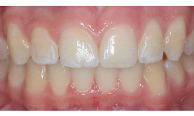 After treatment - Fixed Orthodontic Treatment