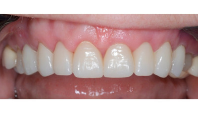 After treatment - Gum Lift, Crown and Veneers 
