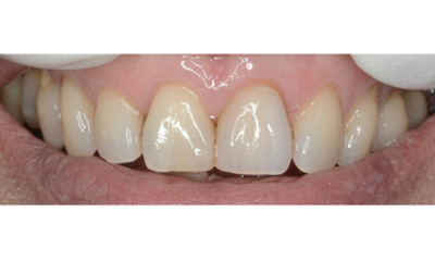 After treatment - Single Crown Colour Matching 