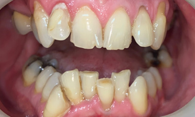 Before treatment - Clear Aligners and Crowns/Veneers 