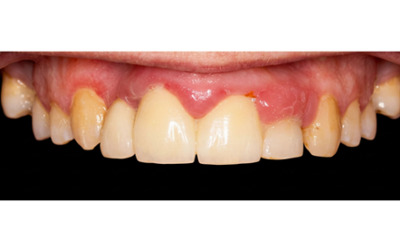Before treatment - Dental Implant and Bridge Treatment