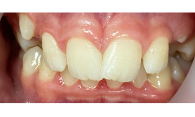 Before treatment - Fixed Orthodontic Treatment