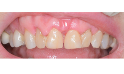 Before treatment - Gum Lift, Crown and Veneers 