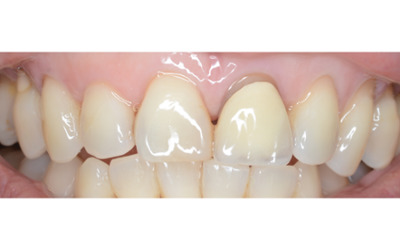 Before treatment - Single Crown Colour Matching 